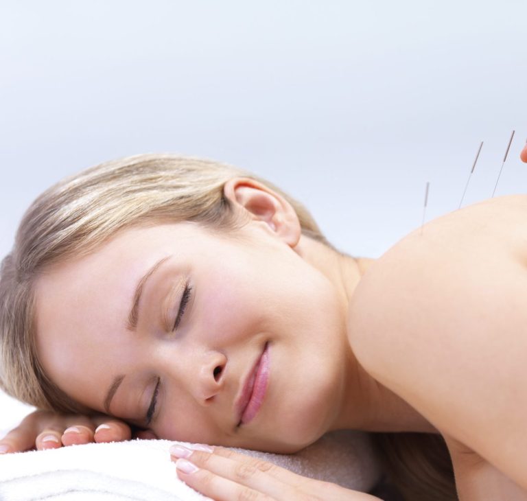 Acupuncture